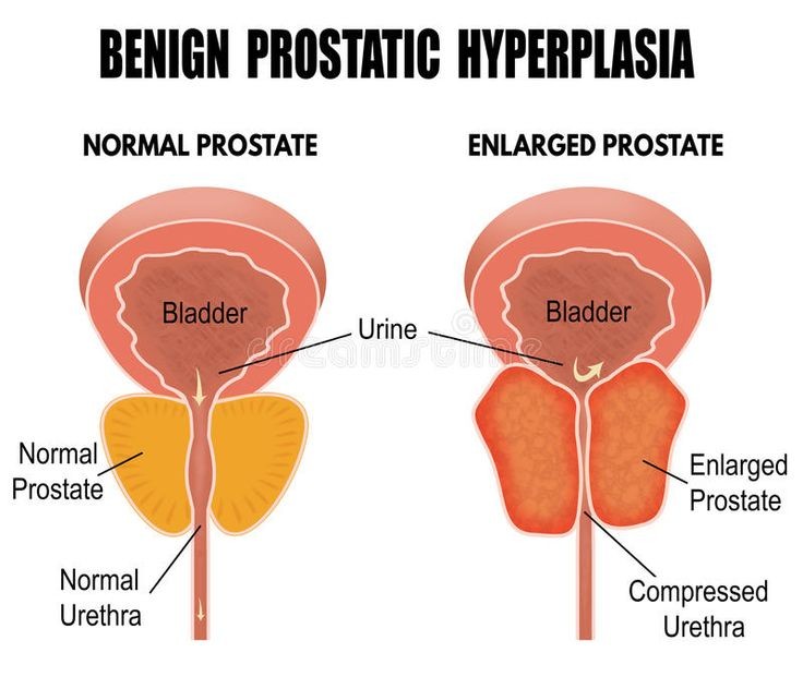 "Illustration of Benign Prostatic Hyperplasia (BPH), showing an enlarged prostate gland pressing against the urethra and bladder, causing urinary flow obstruction in men."